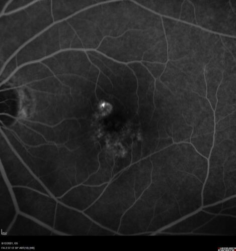 Occult Choroidal Neovascular Membrane
66 year old man with vision loss in the left eye for 2 months
VA 20/20 OD, 20/63 OS
