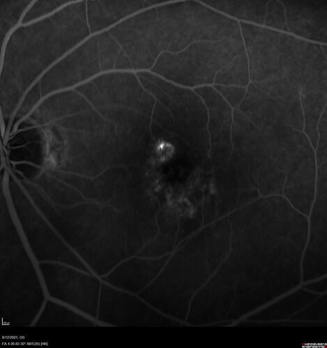 Occult Choroidal Neovascular Membrane
66 year old man with vision loss in the left eye for 2 months
VA 20/20 OD, 20/63 OS
