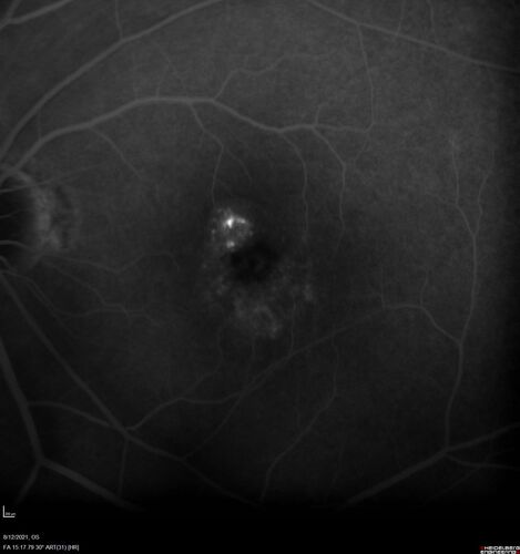Occult Choroidal Neovascular Membrane
66 year old man with vision loss in the left eye for 2 months
VA 20/20 OD, 20/63 OS

