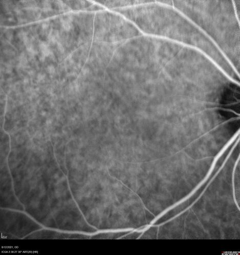 Occult Choroidal Neovascular Membrane
66 year old man with vision loss in the left eye for 2 months
VA 20/20 OD, 20/63 OS
