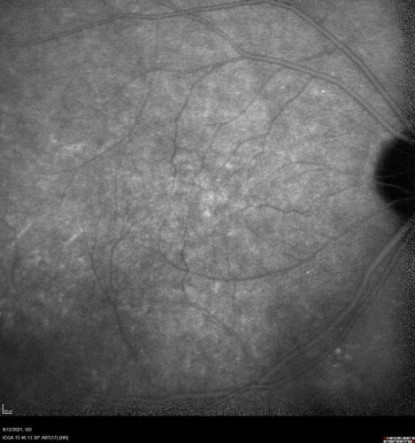 Occult Choroidal Neovascular Membrane
66 year old man with vision loss in the left eye for 2 months
VA 20/20 OD, 20/63 OS
