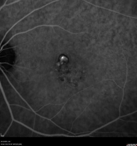 Occult Choroidal Neovascular Membrane
66 year old man with vision loss in the left eye for 2 months
VA 20/20 OD, 20/63 OS
