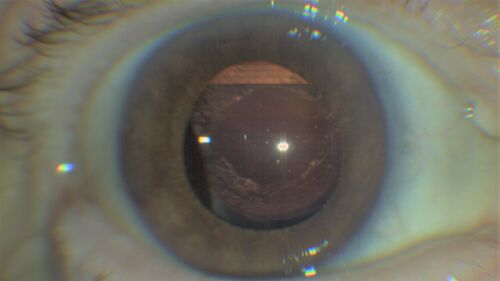 Idiopathic Iris Cyst
85 year old man History of wet AMD OD x 7 years under treatment with Lucentis.  VA 20/40 OD, 20/32 OS
PMHx High cholesterol, GERD, COPD, A-Fib, 
MEDS: coumadin and ASA and others
