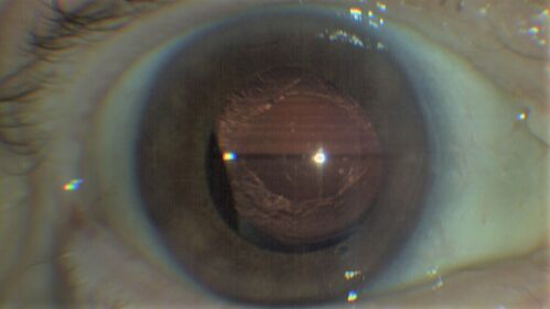 Idiopathic Iris Cyst
85 year old man History of wet AMD OD x 7 years under treatment with Lucentis.  VA 20/40 OD, 20/32 OS
PMHx High cholesterol, GERD, COPD, A-Fib, 
MEDS: coumadin and ASA and others
