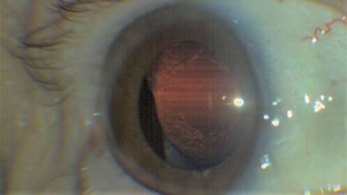 Idiopathic Iris Cyst
85 year old man History of wet AMD OD x 7 years under treatment with Lucentis.  VA 20/40 OD, 20/32 OS
PMHx High cholesterol, GERD, COPD, A-Fib, 
MEDS: coumadin and ASA and others
