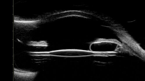 Idiopathic Iris Cyst
85 year old man History of wet AMD OD x 7 years under treatment with Lucentis.  VA 20/40 OD, 20/32 OS
PMHx High cholesterol, GERD, COPD, A-Fib, 
MEDS: coumadin and ASA and others
