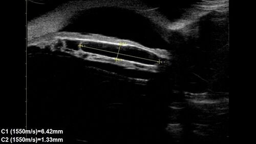Idiopathic Iris Cyst
85 year old man History of wet AMD OD x 7 years under treatment with Lucentis.  VA 20/40 OD, 20/32 OS
PMHx High cholesterol, GERD, COPD, A-Fib, 
MEDS: coumadin and ASA and others
