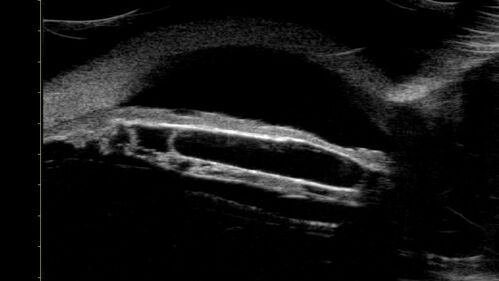 Idiopathic Iris Cyst
85 year old man History of wet AMD OD x 7 years under treatment with Lucentis.  VA 20/40 OD, 20/32 OS
PMHx High cholesterol, GERD, COPD, A-Fib, 
MEDS: coumadin and ASA and others
