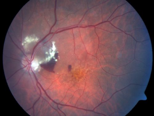 Juxtapapillary CNVM and Serous Macular Detachment Wet AMD Rx Laser
85-year-old man OD is 20/25, OS is 20/100.  IOP:  OD 21, OS 22.  

OS:   Vertical C/D ratio is 0.1.  There is a posterior vitreous separation.  There is a hemorrhagic pigment epithelial detachment on the superior pole of the optic nerve, extending a disc-and-a-half diameter off the nerve, with adjacent exudates.  There is a serous macular detachment involving the center of the fovea.  

VA improved from 20/100 to 20/50 in four months from laser.
Võtmesõnad: wet; juxtapapillary;laser;amd;serous;detachment