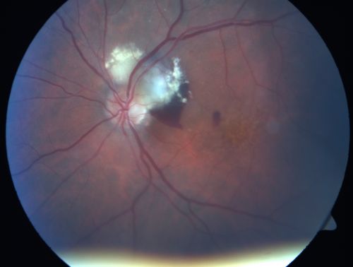 Juxtapapillary CNVM and Serous Macular Detachment Wet AMD Rx Laser
85-year-old man OD is 20/25, OS is 20/100.  IOP:  OD 21, OS 22.  

OS:   Vertical C/D ratio is 0.1.  There is a posterior vitreous separation.  There is a hemorrhagic pigment epithelial detachment on the superior pole of the optic nerve, extending a disc-and-a-half diameter off the nerve, with adjacent exudates.  There is a serous macular detachment involving the center of the fovea.  

VA improved from 20/100 to 20/50 in four months from laser.
Keywords: wet; juxtapapillary;laser;amd;serous;detachment