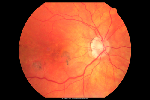 Late Onset Retinal Degeneration (L-ORD)
55 year old with acute vision loss from a CNVM in the right eye.  He responded to Lucentis therapy.  His mother and her family has been confirmed genetically to have L-ORD and were part of the early reports.
