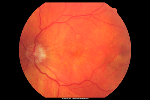 Late Onset Retinal Degeneration (L-ORD)
55 year old with acute vision loss from a CNVM in the right eye.  He responded to Lucentis therapy.  His mother and her family has been confirmed genetically to have L-ORD and were part of the early reports.
