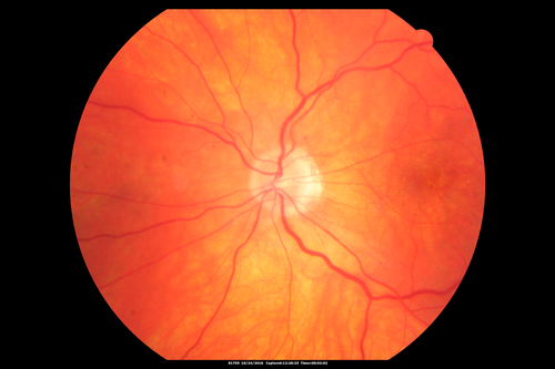 Late Onset Retinal Degeneration (L-ORD)
55 year old with acute vision loss from a CNVM in the right eye.  He responded to Lucentis therapy.  His mother and her family has been confirmed genetically to have L-ORD and were part of the early reports.
