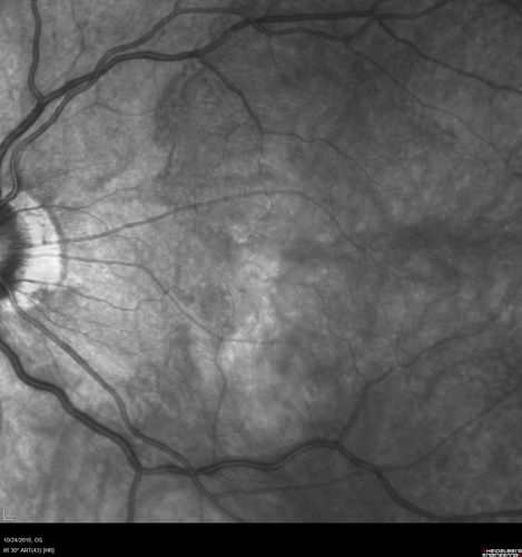 Late Onset Retinal Degeneration (L-ORD)
55 year old with acute vision loss from a CNVM in the right eye.  He responded to Lucentis therapy.  His mother and her family has been confirmed genetically to have L-ORD and were part of the early reports.
