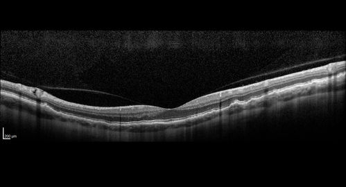 Late Onset Retinal Degeneration (L-ORD)
55 year old with acute vision loss from a CNVM in the right eye.  He responded to Lucentis therapy.  His mother and her family has been confirmed genetically to have L-ORD and were part of the early reports.
