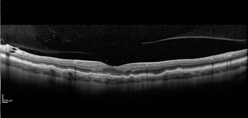Late Onset Retinal Degeneration (L-ORD)
55 year old with acute vision loss from a CNVM in the right eye.  He responded to Lucentis therapy.  His mother and her family has been confirmed genetically to have L-ORD and were part of the early reports.
