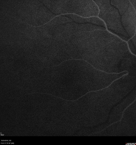 Late Onset Retinal Degeneration (L-ORD)
55 year old with acute vision loss from a CNVM in the right eye.  He responded to Lucentis therapy.  His mother and her family has been confirmed genetically to have L-ORD and were part of the early reports.
