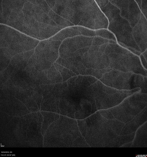 Late Onset Retinal Degeneration (L-ORD)
55 year old with acute vision loss from a CNVM in the right eye.  He responded to Lucentis therapy.  His mother and her family has been confirmed genetically to have L-ORD and were part of the early reports.
