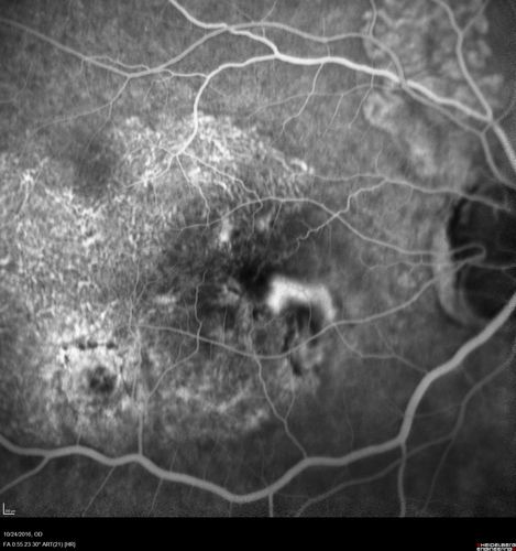 Late Onset Retinal Degeneration (L-ORD)
55 year old with acute vision loss from a CNVM in the right eye.  He responded to Lucentis therapy.  His mother and her family has been confirmed genetically to have L-ORD and were part of the early reports.
