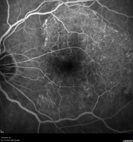 Late Onset Retinal Degeneration (L-ORD)
55 year old with acute vision loss from a CNVM in the right eye.  He responded to Lucentis therapy.  His mother and her family has been confirmed genetically to have L-ORD and were part of the early reports.

