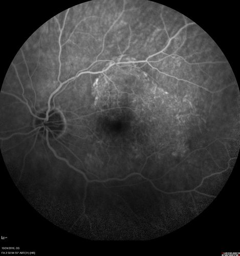 Late Onset Retinal Degeneration (L-ORD)
55 year old with acute vision loss from a CNVM in the right eye.  He responded to Lucentis therapy.  His mother and her family has been confirmed genetically to have L-ORD and were part of the early reports.

