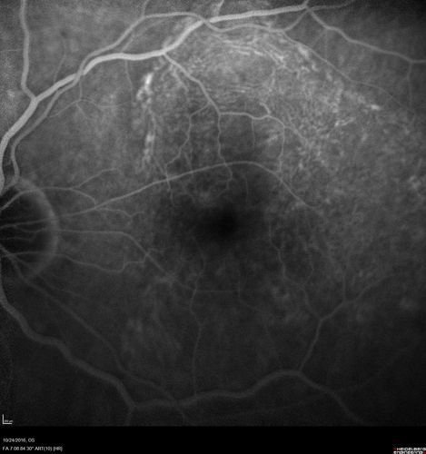 Late Onset Retinal Degeneration (L-ORD)
55 year old with acute vision loss from a CNVM in the right eye.  He responded to Lucentis therapy.  His mother and her family has been confirmed genetically to have L-ORD and were part of the early reports.
