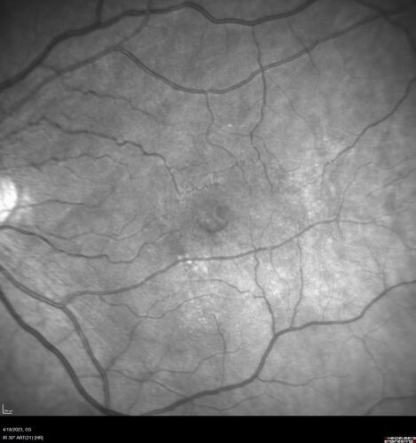Lamellar Macular Hole and Good Vision
67 year old woman with good vision and floaters - VA 20/32 OD, 20/23 OS

