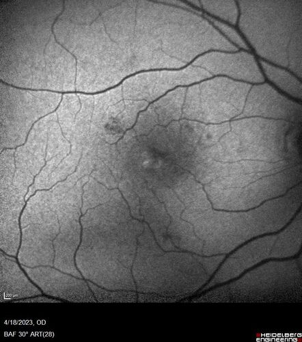 Lamellar Macular Hole and Good Vision
67 year old woman with good vision and floaters - VA 20/32 OD, 20/23 OS

