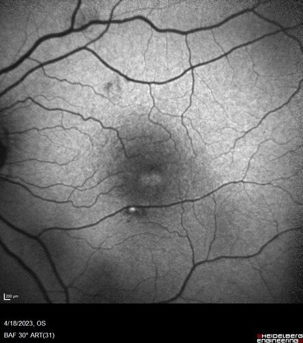 Lamellar Macular Hole and Good Vision
67 year old woman with good vision and floaters - VA 20/32 OD, 20/23 OS
