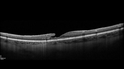 Lamellar Macular Hole and Good Vision
67 year old woman with good vision and floaters - VA 20/32 OD, 20/23 OS
