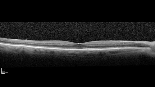 Ruptured Retinal Arterial Macroaneurysm - Submacular hemorrhage and BRAO
81 year old female with vision loss for a few days.  Coumadin was high with INR at 3.1 VA 6/200

