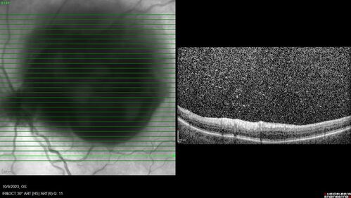 Ruptured Retinal Arterial Macroaneurysm - Submacular hemorrhage and BRAO
81 year old female with vision loss for a few days.  Coumadin was high with INR at 3.1 VA 6/200
