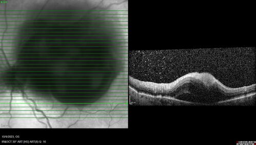 Ruptured Retinal Arterial Macroaneurysm - Submacular hemorrhage and BRAO
81 year old female with vision loss for a few days.  Coumadin was high with INR at 3.1 VA 6/200
