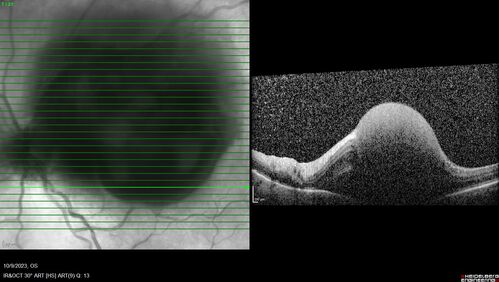Ruptured Retinal Arterial Macroaneurysm - Submacular hemorrhage and BRAO
81 year old female with vision loss for a few days.  Coumadin was high with INR at 3.1 VA 6/200
