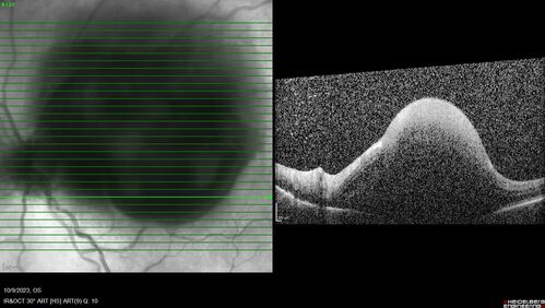 Ruptured Retinal Arterial Macroaneurysm - Submacular hemorrhage and BRAO
81 year old female with vision loss for a few days.  Coumadin was high with INR at 3.1 VA 6/200
