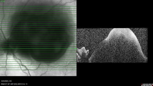 Ruptured Retinal Arterial Macroaneurysm - Submacular hemorrhage and BRAO
81 year old female with vision loss for a few days.  Coumadin was high with INR at 3.1 VA 6/200
