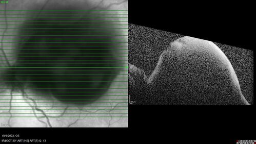 Ruptured Retinal Arterial Macroaneurysm - Submacular hemorrhage and BRAO
81 year old female with vision loss for a few days.  Coumadin was high with INR at 3.1 VA 6/200
