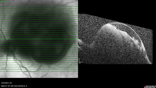 Ruptured Retinal Arterial Macroaneurysm - Submacular hemorrhage and BRAO
81 year old female with vision loss for a few days.  Coumadin was high with INR at 3.1 VA 6/200
