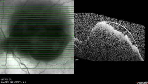 Ruptured Retinal Arterial Macroaneurysm - Submacular hemorrhage and BRAO
81 year old female with vision loss for a few days.  Coumadin was high with INR at 3.1 VA 6/200
