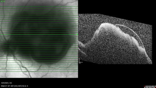 Ruptured Retinal Arterial Macroaneurysm - Submacular hemorrhage and BRAO
81 year old female with vision loss for a few days.  Coumadin was high with INR at 3.1 VA 6/200
