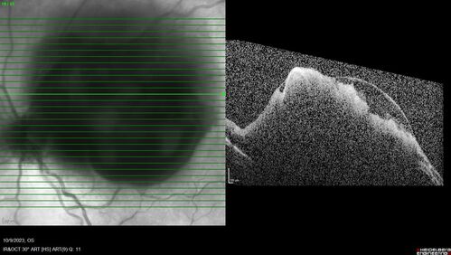 Ruptured Retinal Arterial Macroaneurysm - Submacular hemorrhage and BRAO
81 year old female with vision loss for a few days.  Coumadin was high with INR at 3.1 VA 6/200
