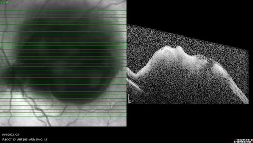 Ruptured Retinal Arterial Macroaneurysm - Submacular hemorrhage and BRAO
81 year old female with vision loss for a few days.  Coumadin was high with INR at 3.1 VA 6/200
