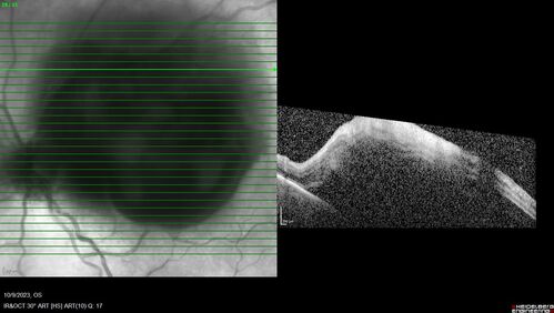 Ruptured Retinal Arterial Macroaneurysm - Submacular hemorrhage and BRAO
81 year old female with vision loss for a few days.  Coumadin was high with INR at 3.1 VA 6/200
