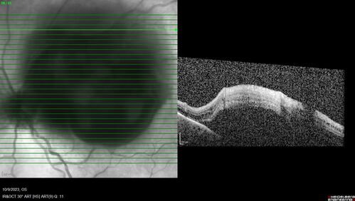 Ruptured Retinal Arterial Macroaneurysm - Submacular hemorrhage and BRAO
81 year old female with vision loss for a few days.  Coumadin was high with INR at 3.1 VA 6/200

