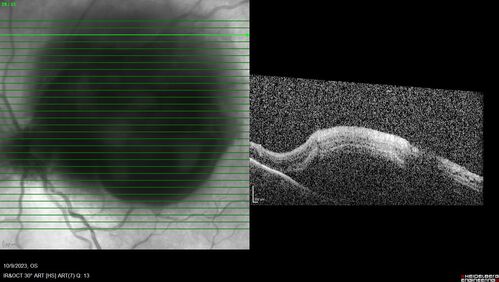 Ruptured Retinal Arterial Macroaneurysm - Submacular hemorrhage and BRAO
81 year old female with vision loss for a few days.  Coumadin was high with INR at 3.1 VA 6/200

