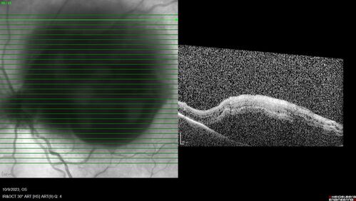 Ruptured Retinal Arterial Macroaneurysm - Submacular hemorrhage and BRAO
81 year old female with vision loss for a few days.  Coumadin was high with INR at 3.1 VA 6/200
