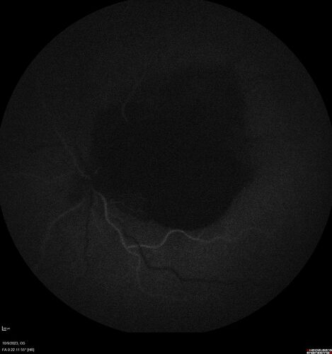Ruptured Retinal Arterial Macroaneurysm - Submacular hemorrhage and BRAO
81 year old female with vision loss for a few days.  Coumadin was high with INR at 3.1 VA 6/200
