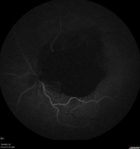 Ruptured Retinal Arterial Macroaneurysm - Submacular hemorrhage and BRAO
81 year old female with vision loss for a few days.  Coumadin was high with INR at 3.1 VA 6/200
