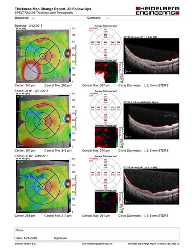 Hyperpigmented Vasoproliferative Tumor on Buckle with New Serous Retinal Detachment 20 years post RD Repair
67 year old female RD repair OU 1999 then severe (20/400) macular pucker OD removed 3 months later (twin sister also had bilateral RDâ€™s with PVR).  Then dislocated IOL surgery right eye 9/2012.  New vision loss in the right eye with serous retinal detachment.  Argon laser to dark tumor led to resolution of subretinal fluid within a month.
