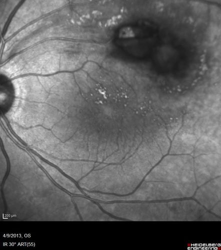 Retinal Arterial Macroaneurysm - Untreated Hypertension (250/135) - Serous Macular Detachment
82 year old asian woman.  VA 20/80 Headaches and vision loss for 1 month.  Negative medical history but has not been to the doctor for years. (no insurance)
